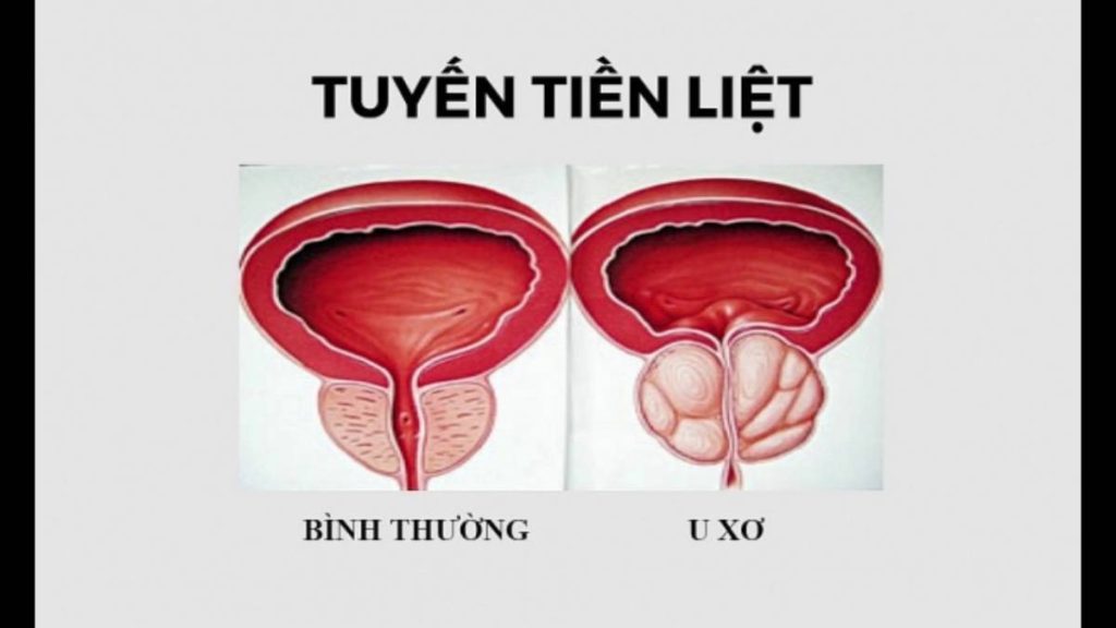 Cách Phòng U Xơ Tiền Liệt Tuyến: Bảo Vệ Sức Khỏe Nam Giới