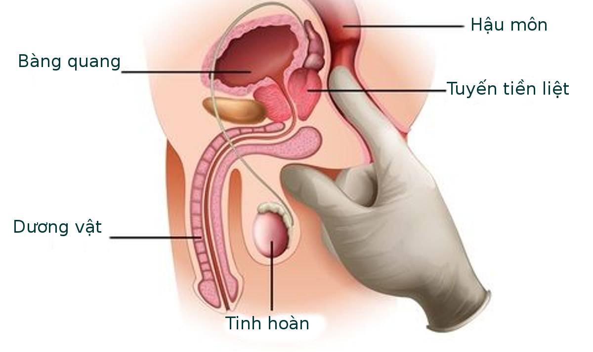 Tại sao viêm tuyến tiền liệt không thể tự khỏi?