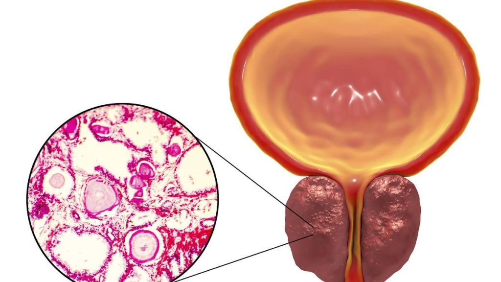 Nang Tuyến Tiền Liệt Là Gì? Triệu Chứng, Nguyên Nhân Và Cách Phòng Ngừa