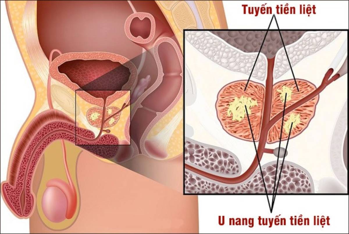 Nang tuyến tiền liệt là gì?