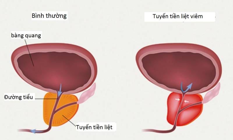 Ảnh hưởng của ăn mặn đến tuyến tiền liệt