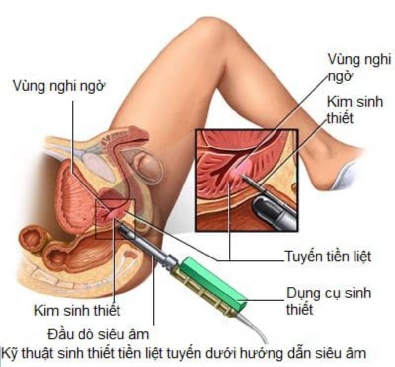 Quy trình sinh thiết tuyến tiền liệt