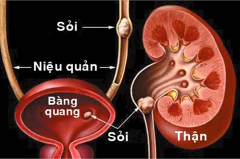 Sỏi tuyến tiền liệt là gì?