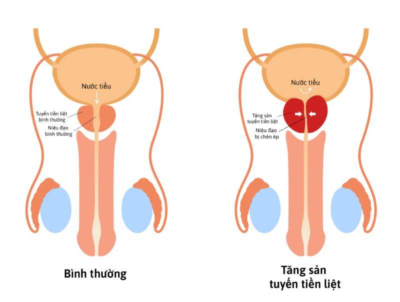 Tăng sản lành tính tuyến tiền liệt là gì?