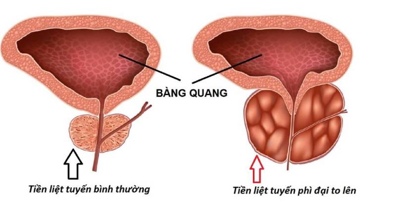 Triệu chứng của tăng sản lành tính tuyến tiền liệt