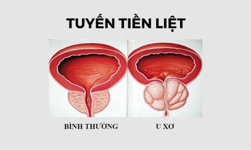 U xơ tuyến tiền liệt là gì?